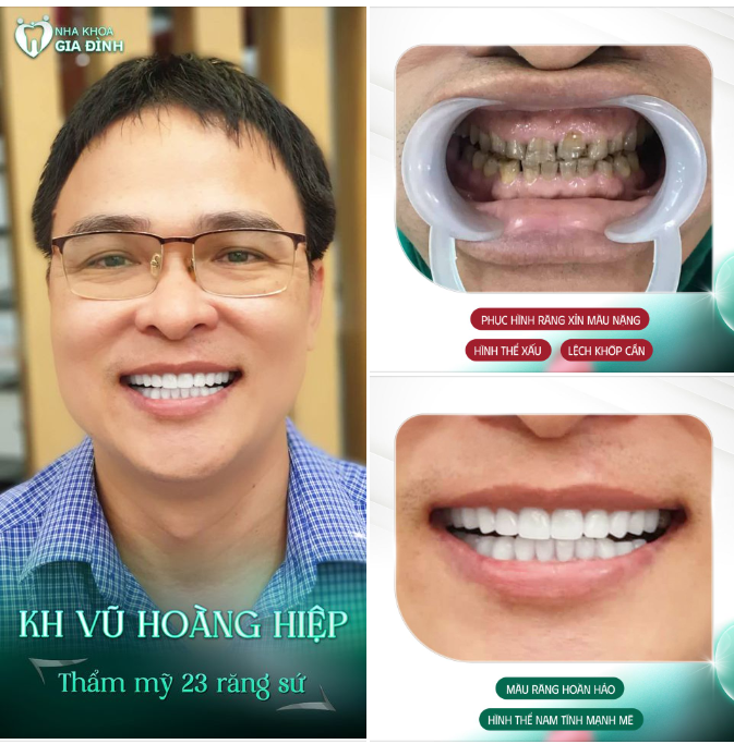 "LỘT XÁC" HOÀN TOÀN SAU KHI THẨM MỸ RĂNG SỨ TẠI NHA KHOA GIA ĐÌNH