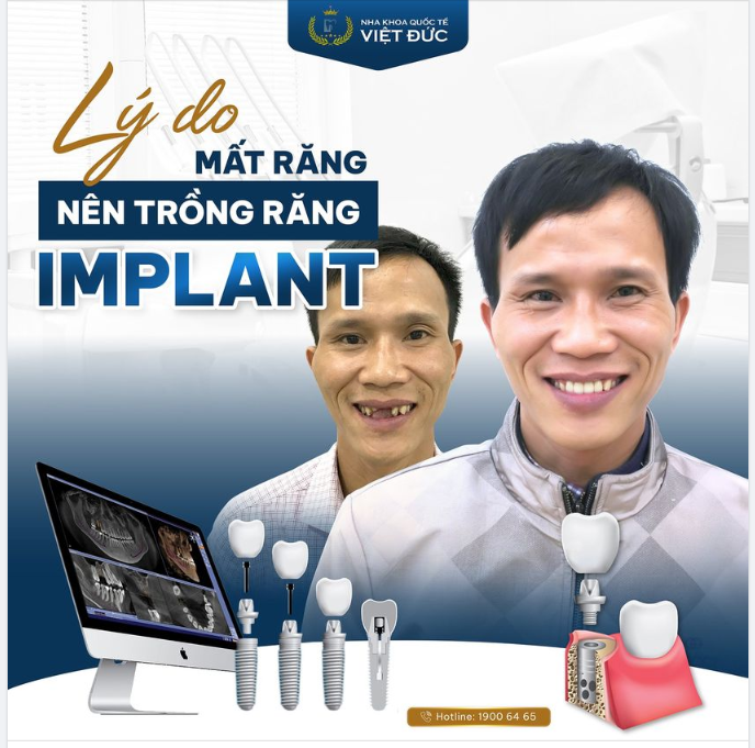 LÝ DO MẤT RĂNG NÊN TRỒNG RĂNG IMPLANT