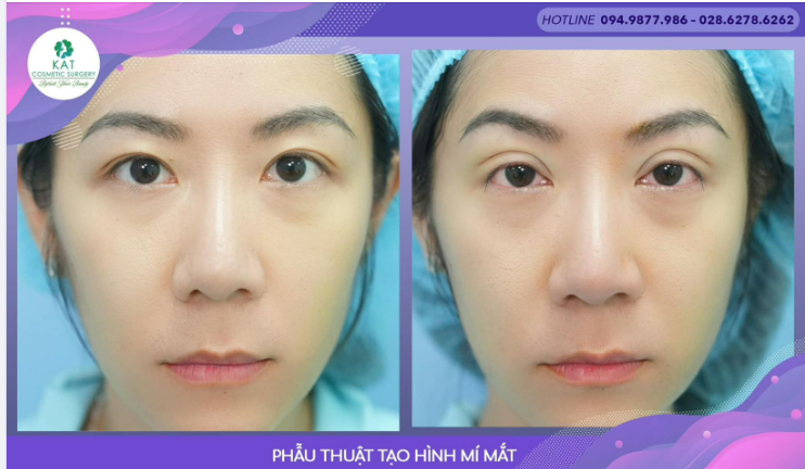 Mắt lồi có nên phẫu thuật tạo hình mí mắt không !