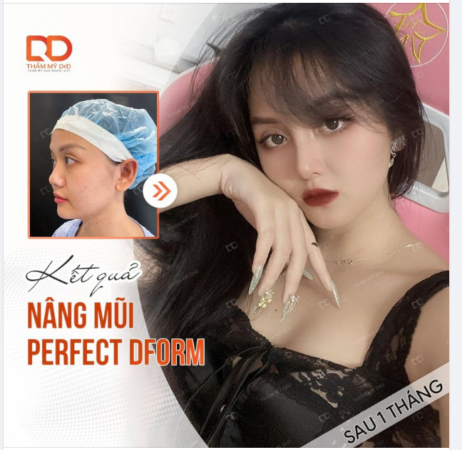 MẶT SẮC NÉT HƠN NHỜ DÁNG MŨI 1 THÁNG.