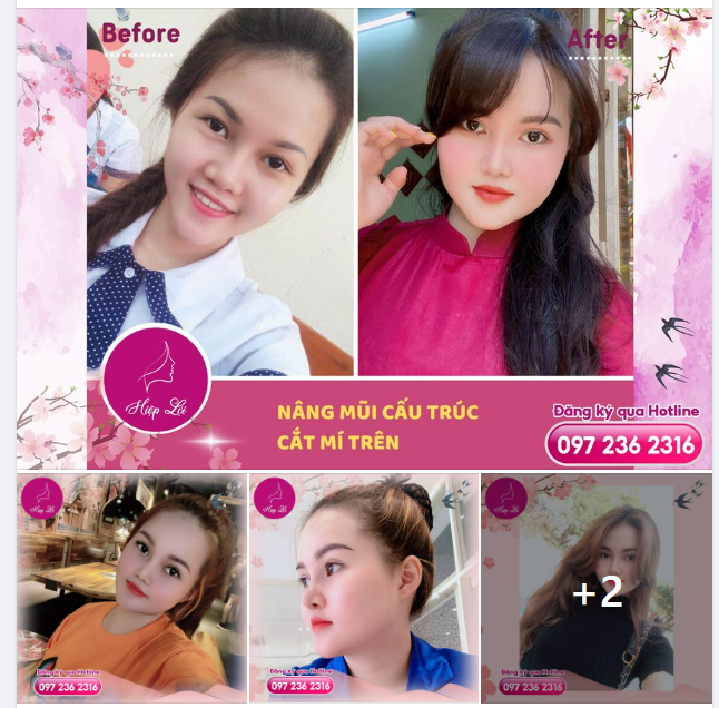 MẶT SẮC NÉT TỪNG GÓC CẠNH SAU KHI CHỌN LÀM COMBO MŨI + MÍ