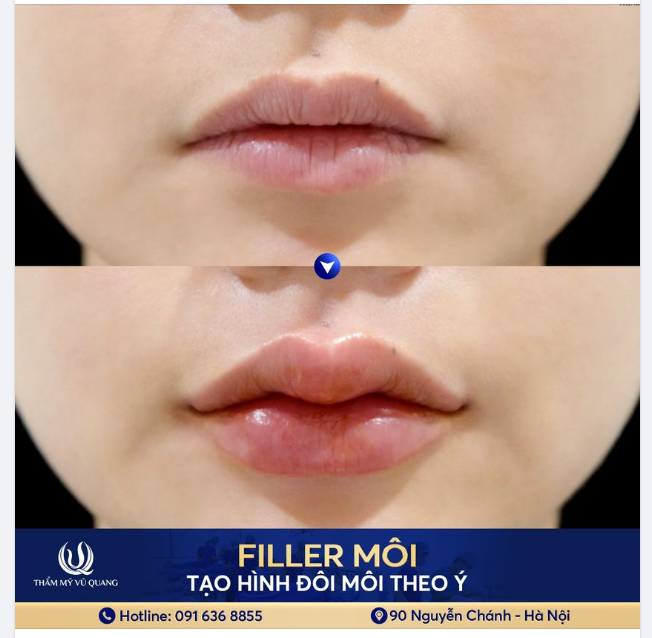 Môi xinh căng mọng với Tiêm filler môi