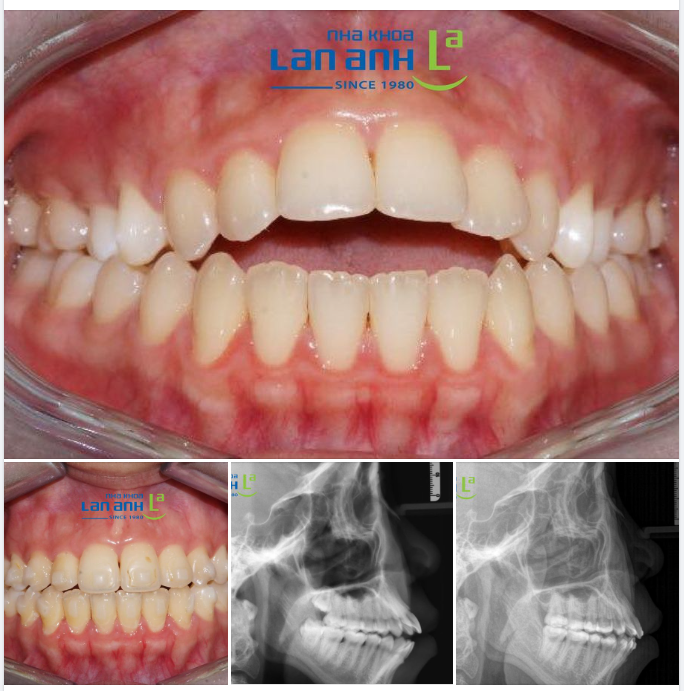 Một ca niềng Invisalign tại nha khoa Lan Anh chi nhánh Phú Nhuận, bác sĩ Huyền và bác sĩ Tuấn Anh điều trị