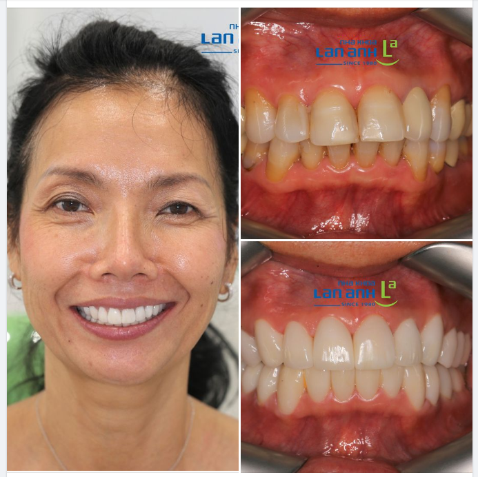 Một ca phục hình sứ toàn hàm tại chi nhánh Sala 2, bác sĩ Đức thực hiện!