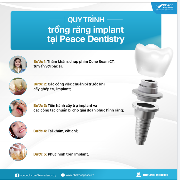 MỘT CA TRỒNG RĂNG IMPLANT SẼ DIỄN RA NHƯ THẾ NÀO?