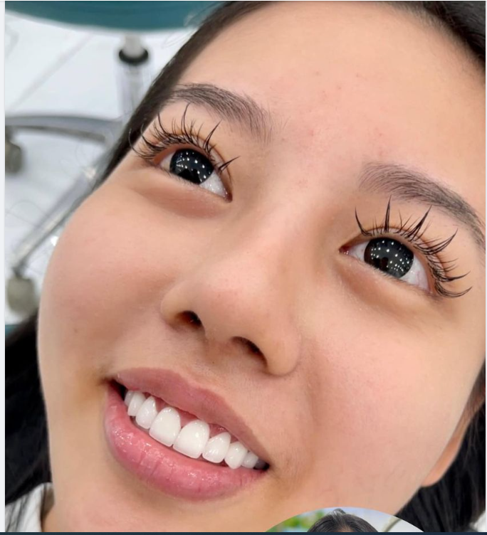 Một kết quả thẩm mỹ răng sứ đẹp long lanh dành cho cô gái Hoài Linh