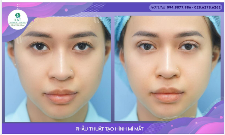 Một tuần mới nhiều năng lượng với đôi mắt 2 mí long lanh