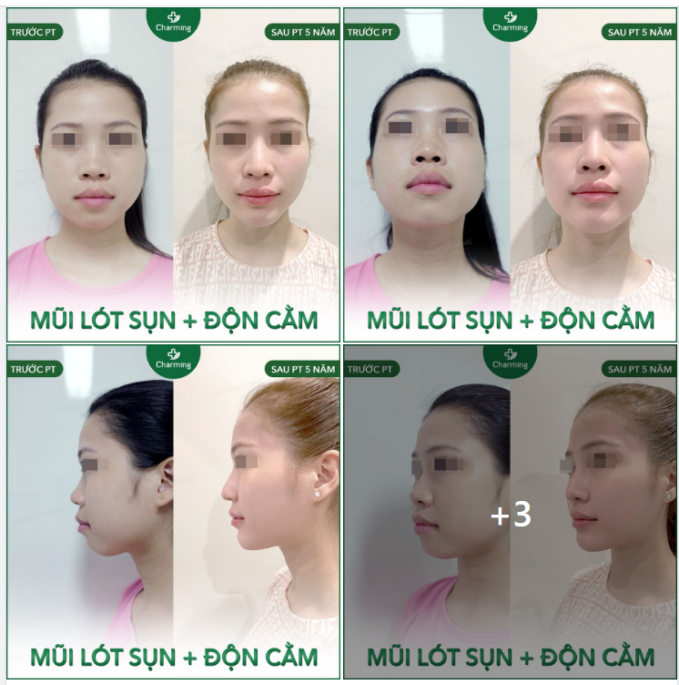 Một vài hình ảnh dáng mũi nhân tạo và lót sụn tai Thẩm mỹ viện Charming tập hợp lại cho Khách hàng dễ tham khảo hơn nhé!