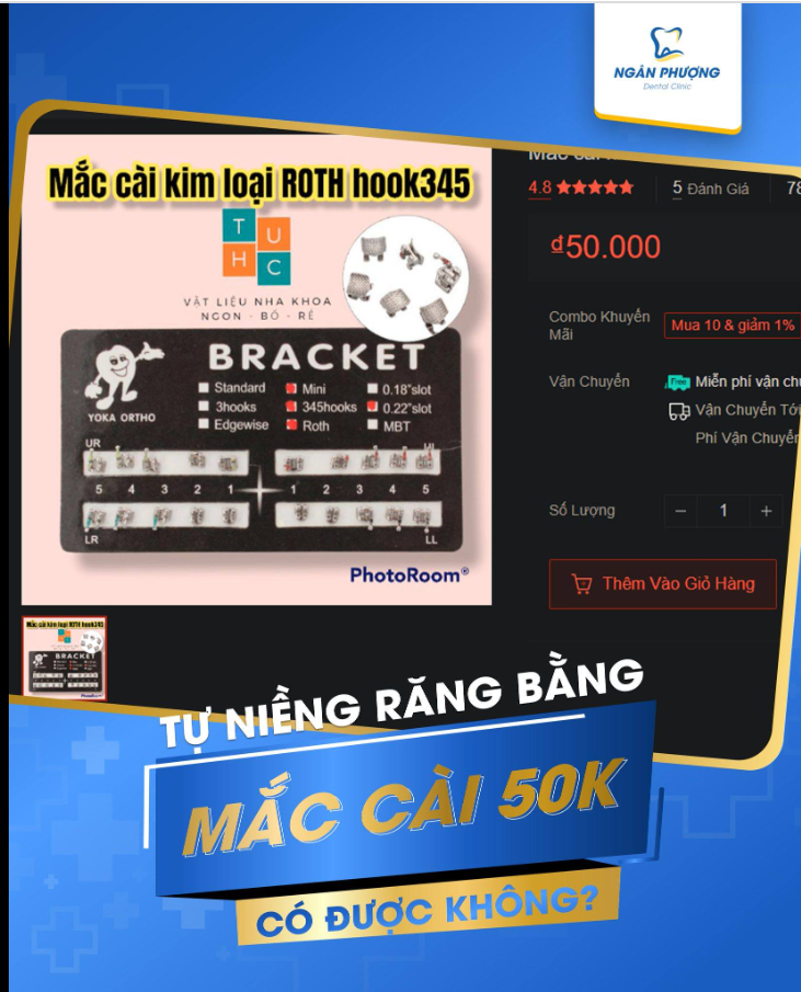 Mua mắc cài 50K tự niềng răng có được không?