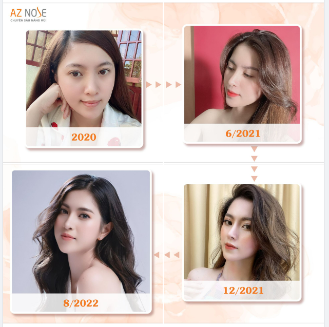 Mũi bác Nam làm hợp với khuôn mặt em lắm ạ!