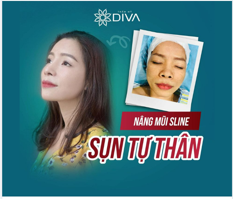 MŨI CAO THANH THOÁT CUỐN HÚT SAU NÂNG MŨI SLINE SỤN TỰ THÂN