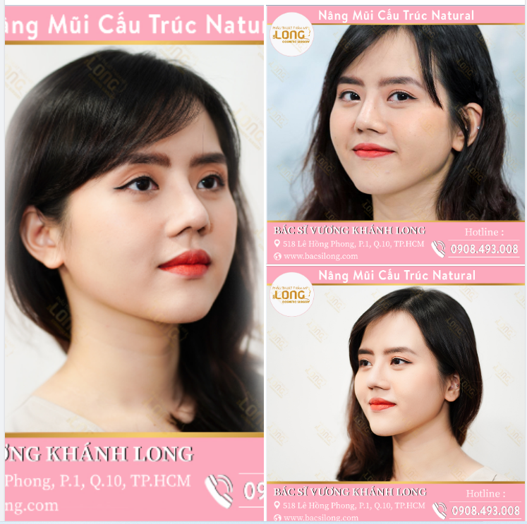 Mũi cấu trúc Natural phương pháp vạn năng giúp bạn có dáng mũi xinh đẹp