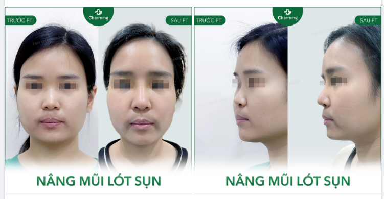 Mũi cũ của khách này khá thẳng, ít khuyết điểm nhưng da mũi lại không dày