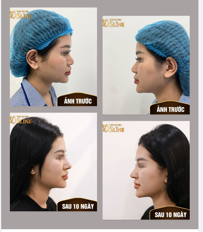 Mũi đẹp cùng Sline Khách hàng nâng mũi Cấu Trúc sau 10 ngày tái khám.