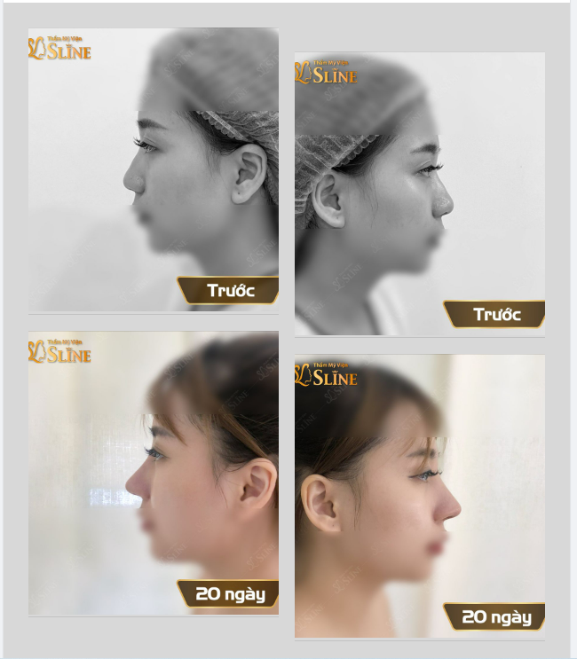 Mũi đẹp sau 20 ngày tái khám
