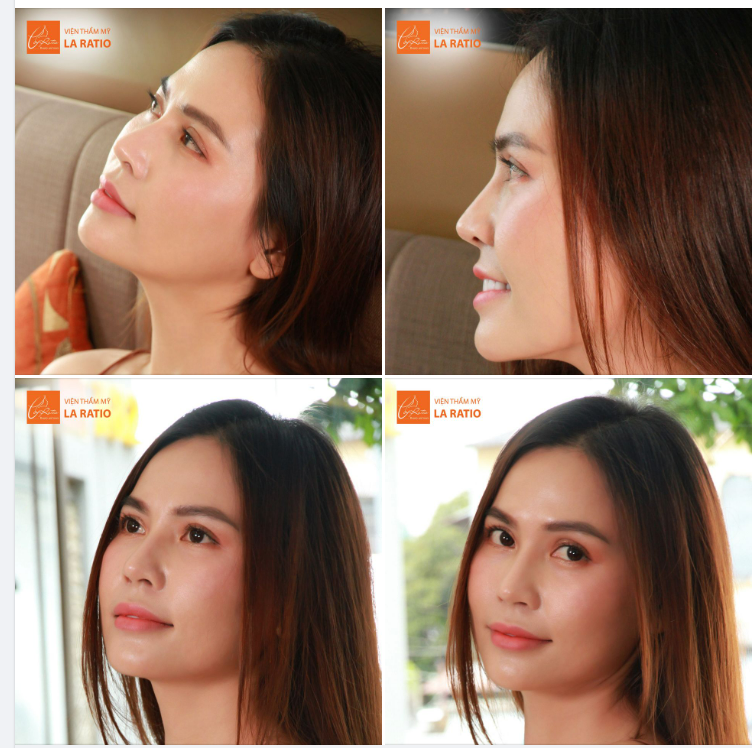 Mũi đẹp Thần thái - Sáng bừng nhan sắc cùng công nghệ nâng mũi ĐỘC QUYỀN tại La Ratio