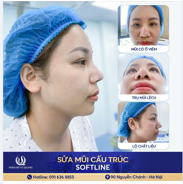 Mũi lệch, viêm nhiễm, lộ chất liệu được sửa lại như thế nào