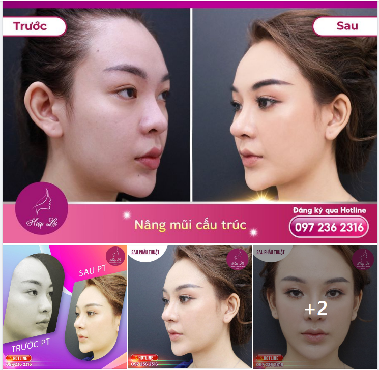 MŨI LÊN FORM ĐẸP SANG XỊN CHỈ SAU 02 LẦN GẶP BS HIỆP LỢI