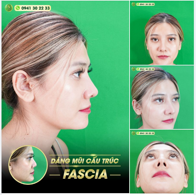MŨI SỬA LẠI ĐẸP THĂNG HẠNG CHUẨN MỌI GÓC ĐỘ