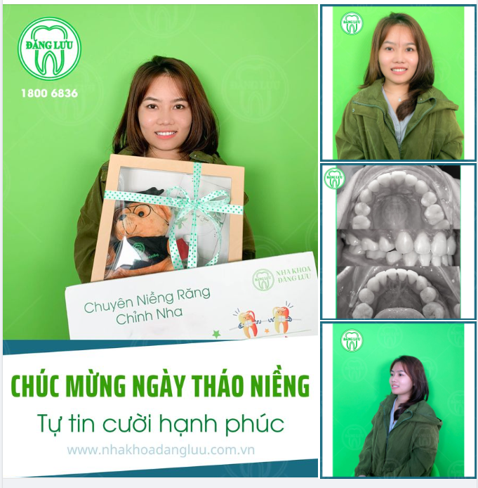 Mừng bạn niềng răng thành công!