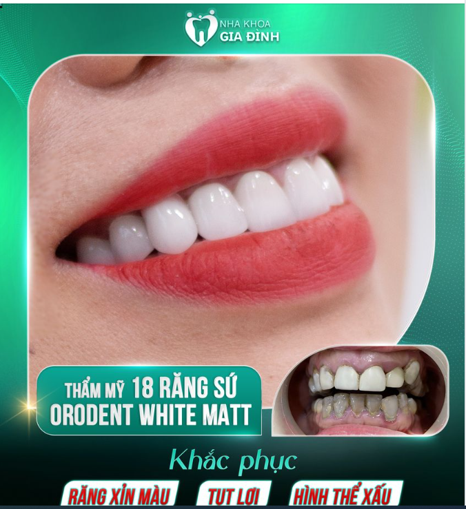 MUỐN RĂNG ĐẸP HƠN HÃY TỚI NHA KHOA GIA ĐÌNH