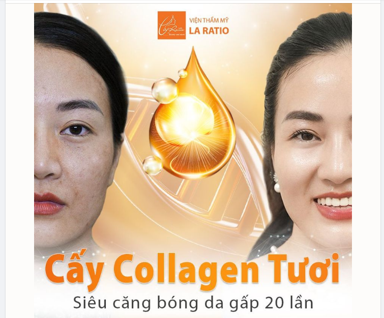 Nâng cấp làn da – CẤY COLLAGEN TƯƠI