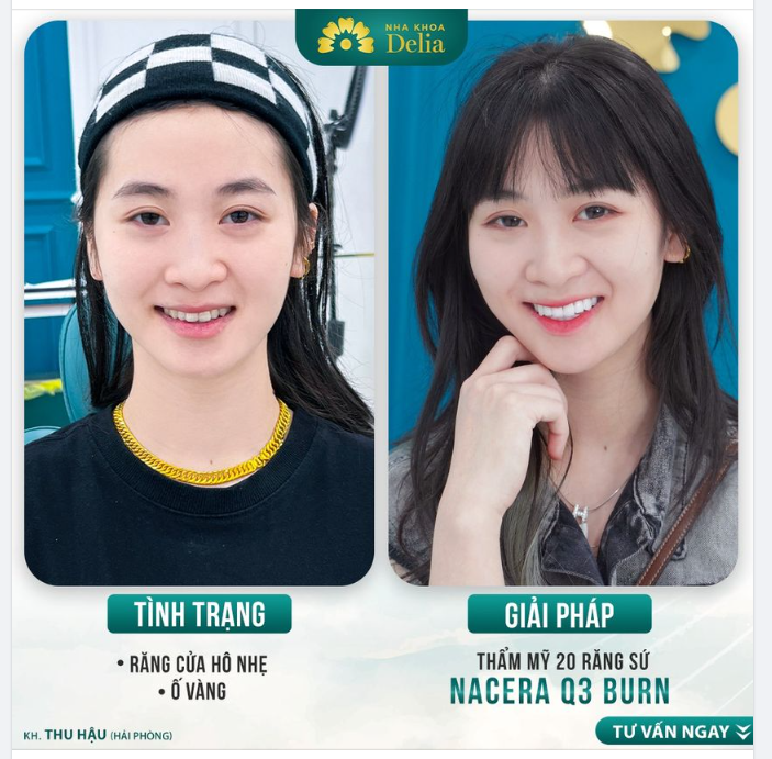 Nâng cấp thần thái, chuẩn gái Hải Phòng sau thẩm mỹ răng sứ tại Delia