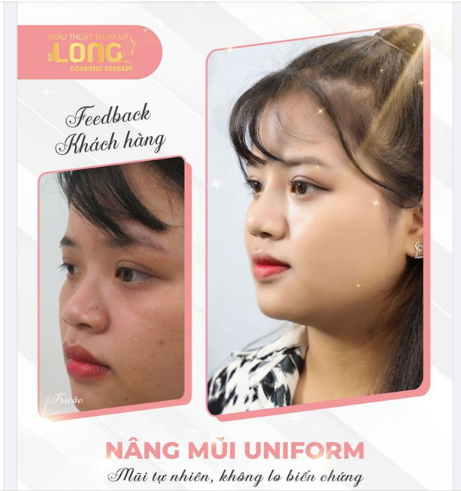 NÀNG MẶT TRÒN NÊN CHỌN NÂNG MŨI NHƯ THẾ NÀO
