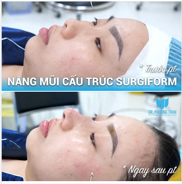 Nâng “MỘT PHÁT ĂN NGAY” chính là nói về ca mũi này!