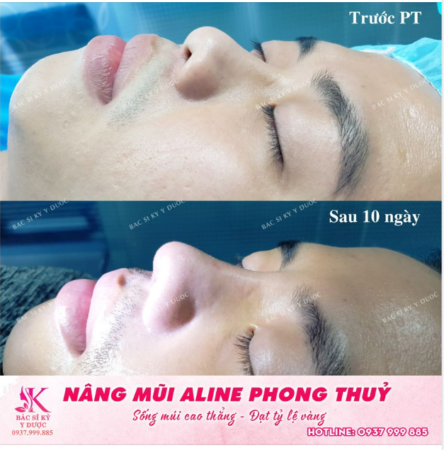 Nâng mũi ALINE - Dáng mũi phong thủy