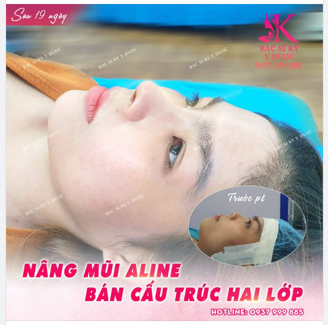 NÂNG MŨI AN TOÀN - GIÁ SIÊU HẠT DẺ TẠI BS KỲ Y DƯỢC