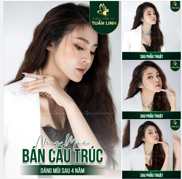 NÂNG MŨI BÁN CẤU TRÚC CHỈ 25 TR SALE LỚN MỪNG 20 10