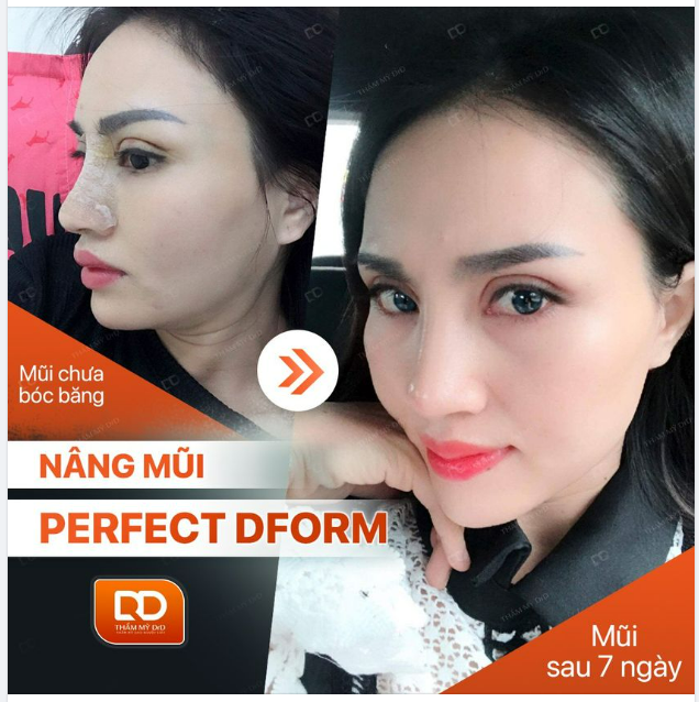 NÂNG MŨI BAO LÂU THÌ THÁO BĂNG ÉP