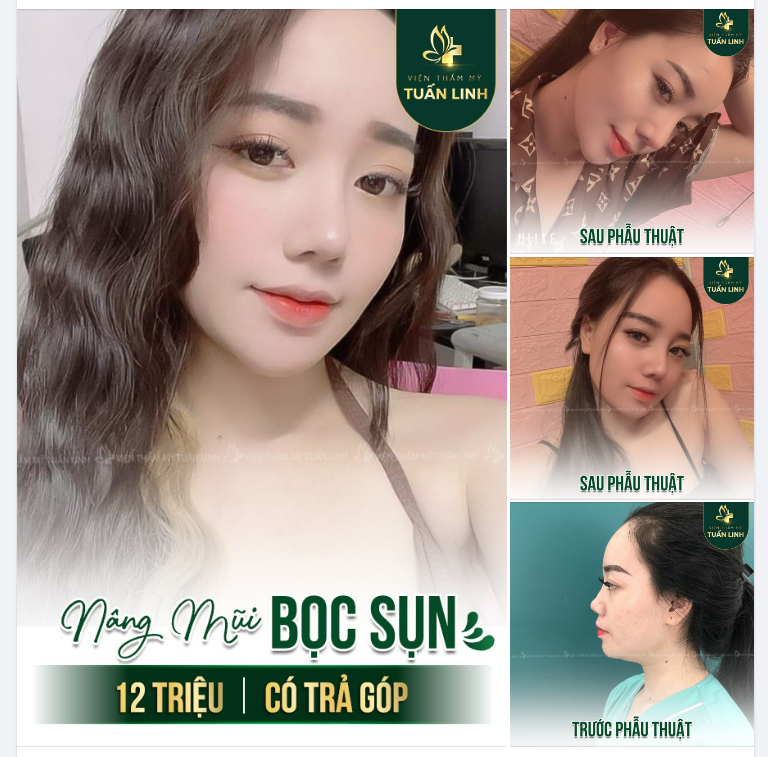 Nâng mũi bọc sụn giá chỉ 12 triệu