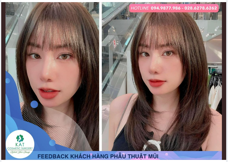 Nâng Mũi Bọc Sụn