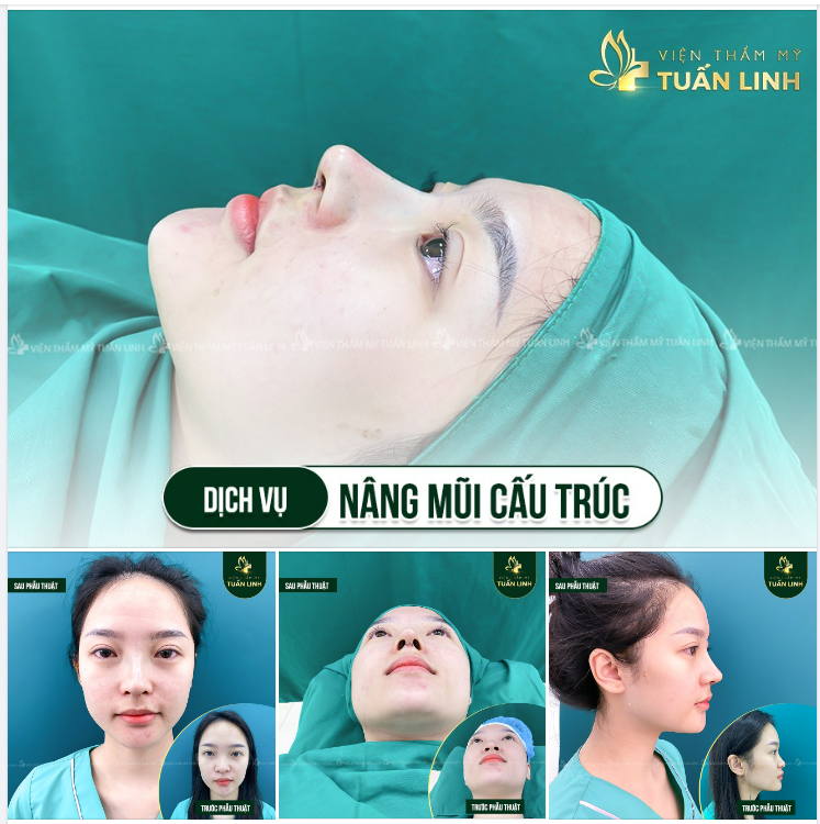 NÂNG MŨI CẤU TRÚC ĐẸP NGAY SAU 90 PHÚT