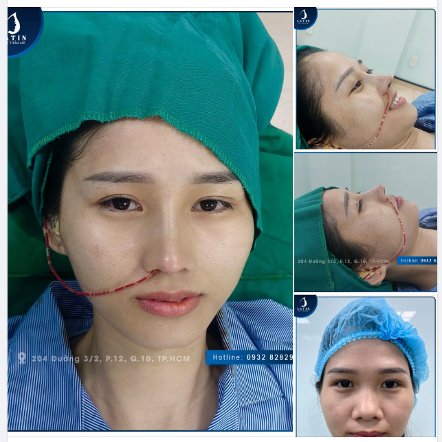 Nâng mũi cấu trúc - Kiến tạo mũi xinh