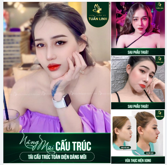 NÂNG MŨI CẤU TRÚC - PHƯƠNG PHÁP TÁI CẤU TRÚC TOÀN DIỆN DÁNG MŨI!!