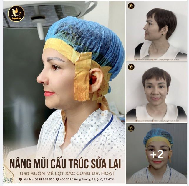NÂNG MŨI CẤU TRÚC SỬA LẠI U50 BUÔN MÊ LỘT XÁC CÙNG DR. HOẠT