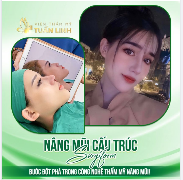 Nâng mũi cấu trúc Sụn surgiform - Bước đột phá công nghệ thẩm mỹ nâng mũi 