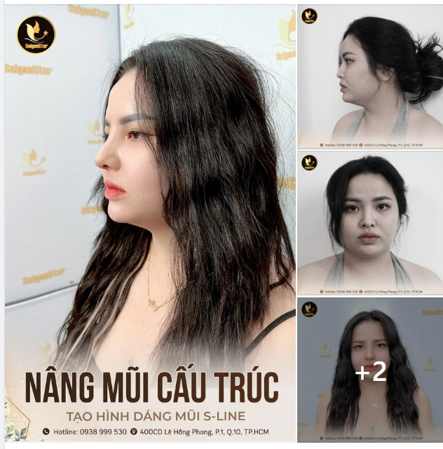 NÂNG MŨI CẤU TRÚC – TẠO HÌNH DÁNG MŨI S-LINE