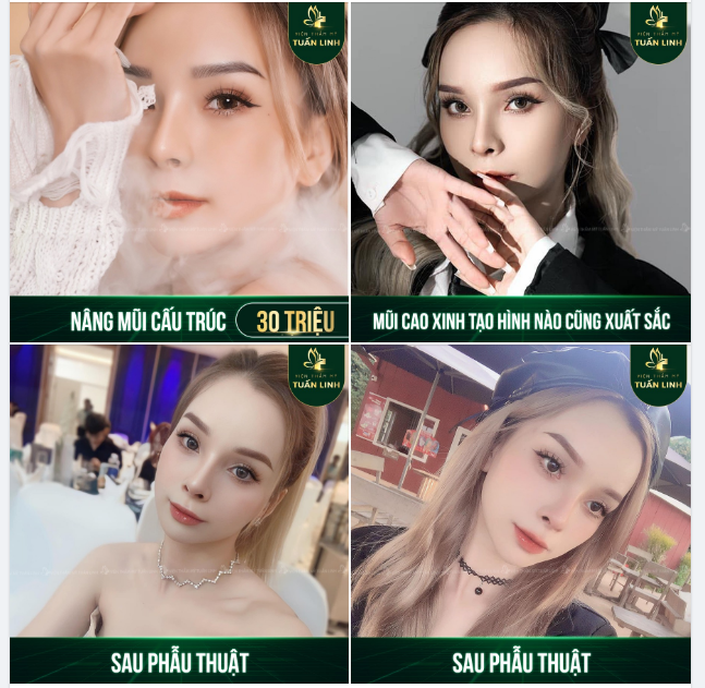 Nâng mũi cấu trúc xong auto xinh