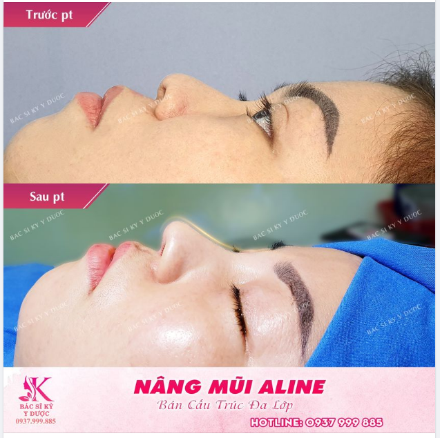 Nâng mũi chỉ 45 phút mà thay đổi hoàn toàn