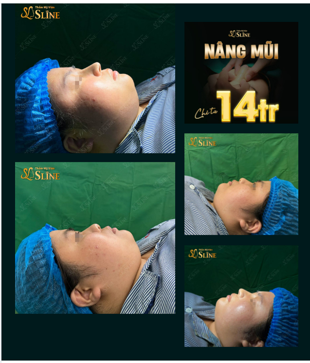 Nâng mũi  Chỉ từ 14tr. Hình ảnh thực tế khách hàng sau khi nâng mũi tại Thẩm Mỹ Viện Sline