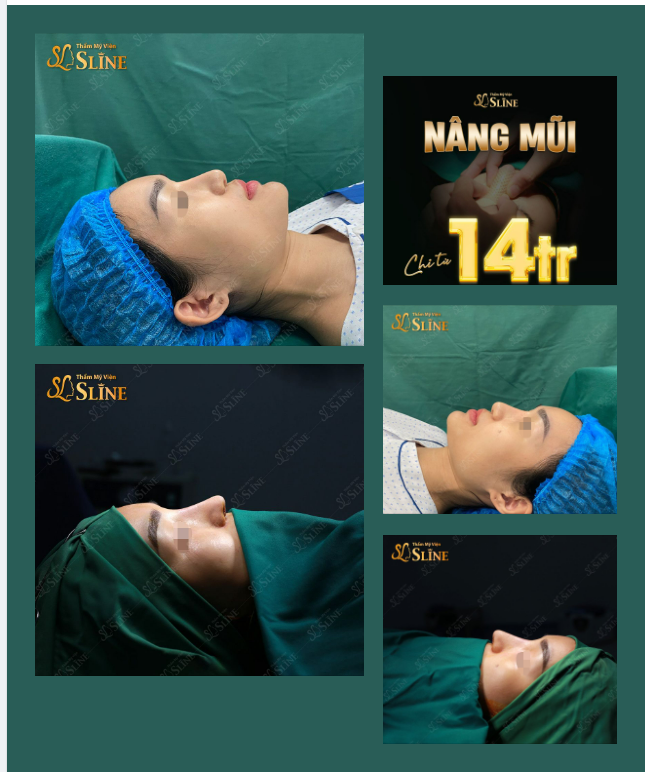 Nâng mũi Chỉ từ 14tr.