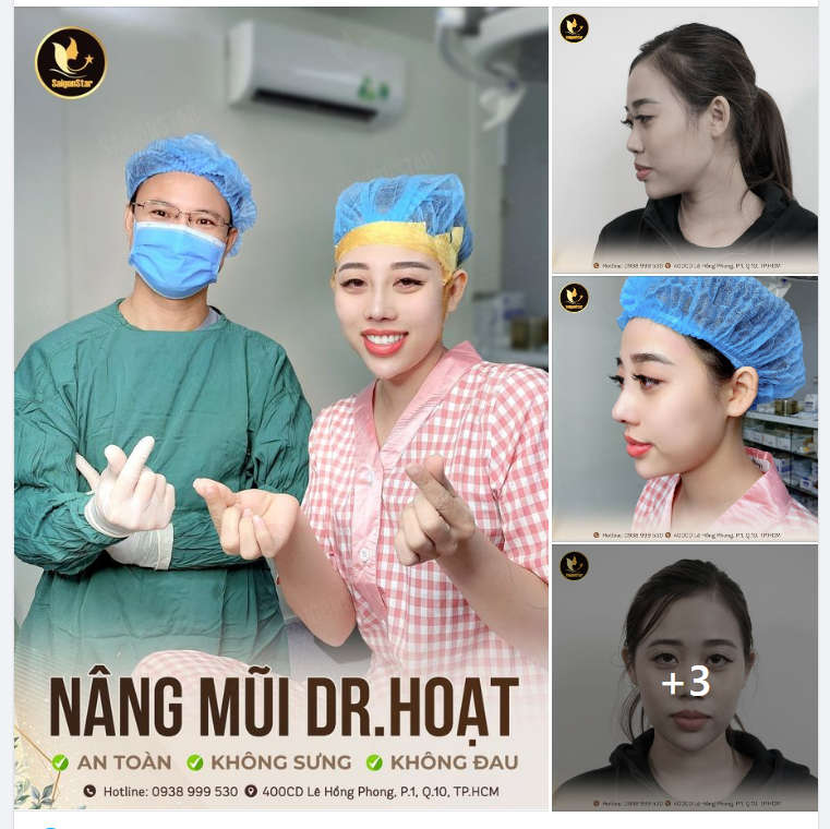 NÂNG MŨI DR. HOẠT AN TOÀN KHÔNG SƯNG KHÔNG ĐAU