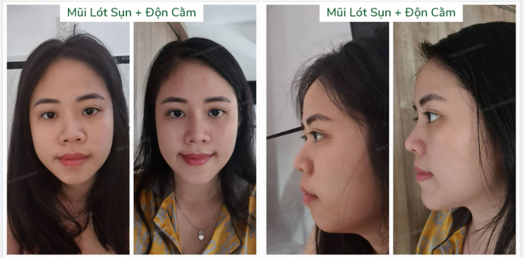 Nâng mũi muốn đẹp cũng phải xem lại tỉ lệ khuôn mặt, đặc biệt là phần cằm. Nếu cằm ngắn mà nâng mũi cao cũng không đẹp được.
