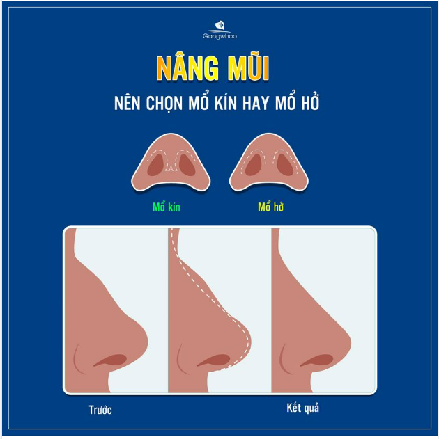 NÂNG MŨI NÊN CHỌN MỔ KÍN HAY MỔ HỞ