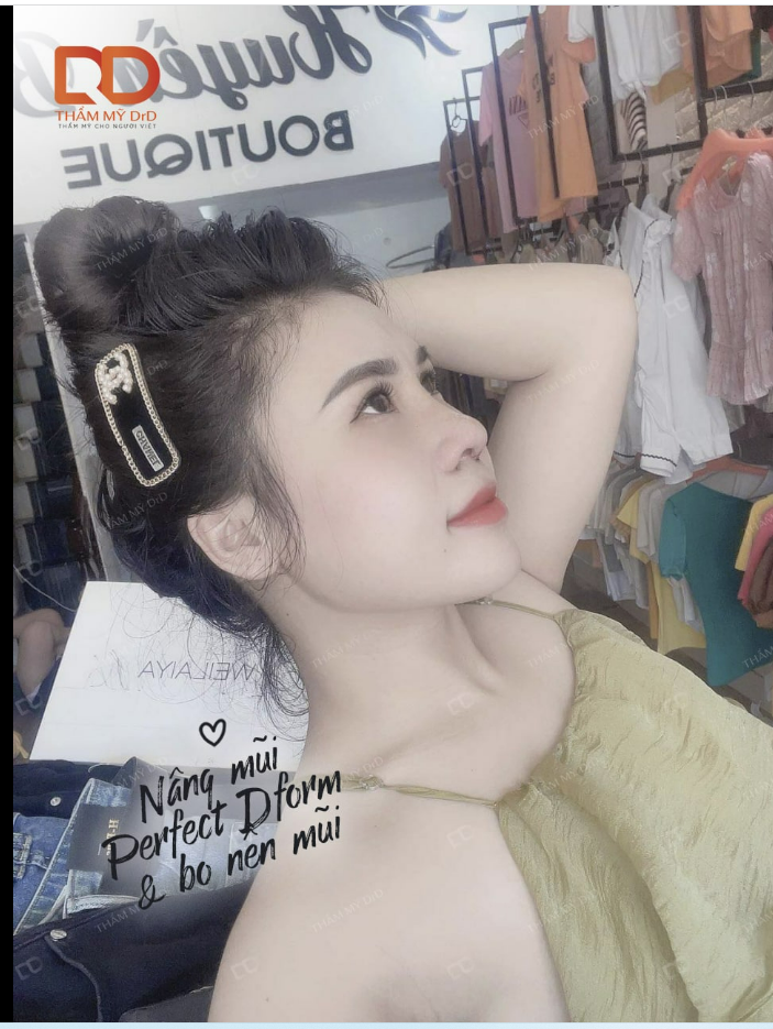NÂNG MŨI PERFECT DFORM KHẮC PHỤC TÌNH TRẠNG ĐẦU MŨI TO