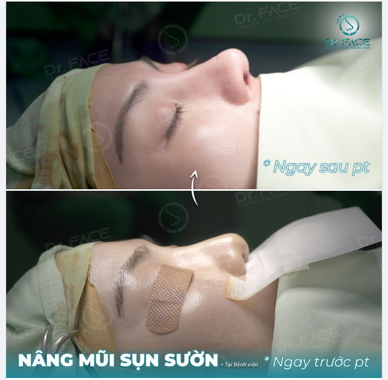 NÂNG MŨI PHẢI TÍNH ĐƯỜNG DÀI…